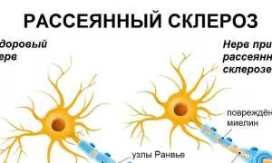 Какие симптомы имеет и как лечится рассеянный склероз?