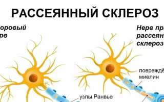 Какие симптомы имеет и как лечится рассеянный склероз?