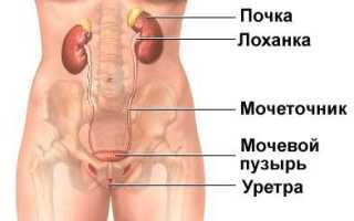 Воспаление мочеточника