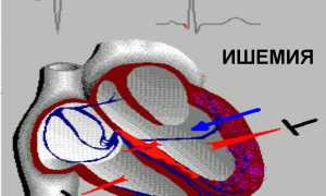 Причины и лечение ишемии (ischemia) сердечной мышцы