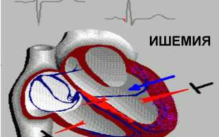 Причины и лечение ишемии (ischemia) сердечной мышцы
