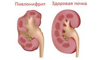 Медикаменты для лечения пиелонефрита