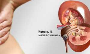 ЛФК для выхода камня из мочеточника