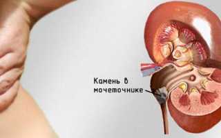 ЛФК для выхода камня из мочеточника