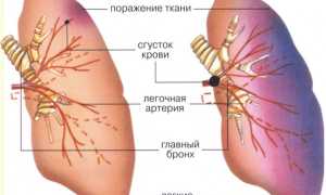 Тромбоэмболия легочной артерии: причины, симптомы, лечение