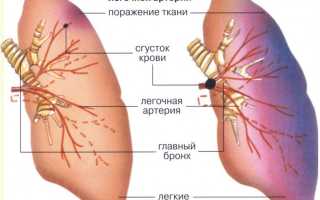 Тромбоэмболия легочной артерии: причины, симптомы, лечение