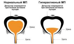Гиперактивный мочевой пузырь и методы лечения