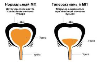 Гиперактивный мочевой пузырь и методы лечения
