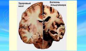 Описание признаков и симптомов болезни Альцгеймера