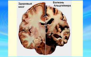 Описание признаков и симптомов болезни Альцгеймера