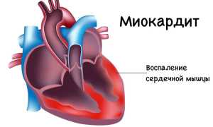 Что такое миокардит: симптомы , диагностика  и лечение