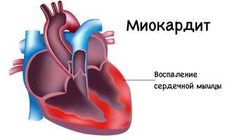 Что такое миокардит: симптомы , диагностика  и лечение