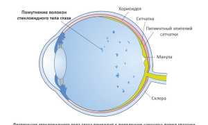 Почему появляются черные мушки перед глазами: причины и лечение