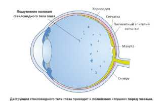 Почему появляются черные мушки перед глазами: причины и лечение