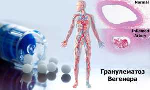 Что такое болезнь Вегенера и чем она опасна