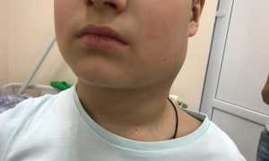 Лимфома Ходжкина: причины, симптомы и лечение болезни