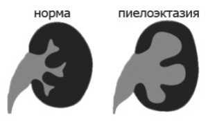 Что такое умеренная пиелоэктазия