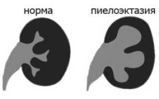 Что такое умеренная пиелоэктазия