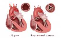 Стеноз аортального клапана: что это такое, как лечить и стоит ли бояться