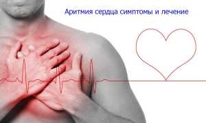Аритмия сердца: что это такое, симптомы и лечение