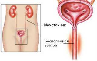 Уретрит у женщин