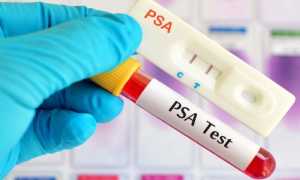 Расшифровка psa анализа крови: норма по возрасту